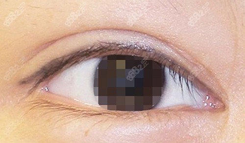 開眼角過長(zhǎng)