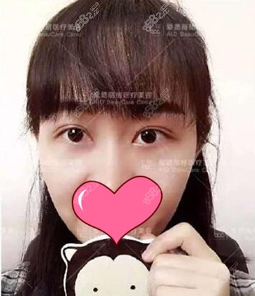 眼综合恢复3个月 眼综合恢复3个月