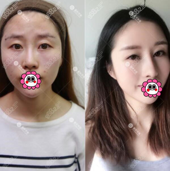 重庆华美李任隆鼻案例