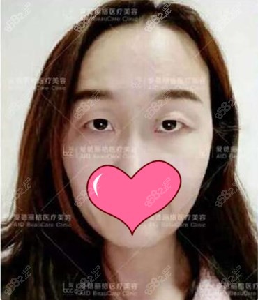 双眼皮手术前 双眼皮手术前