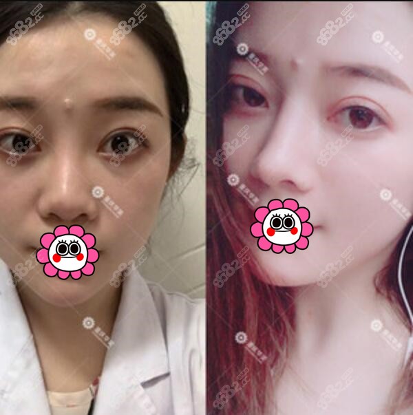 重庆华美李超隆鼻案例