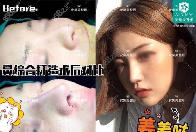 <!--<i data=20240705-sp></i>-->明隆鼻真人案例