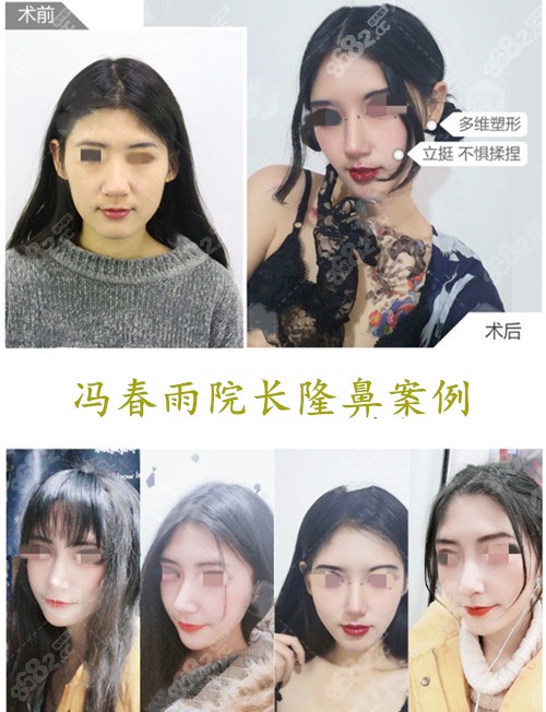 成都美容<!--<i data=20240705-sp></i>-->鼻型矫正真人案例