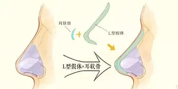 L型假体结合耳软骨隆鼻的示意图