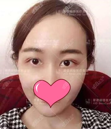 眼综合恢复1个月 眼综合恢复1个月