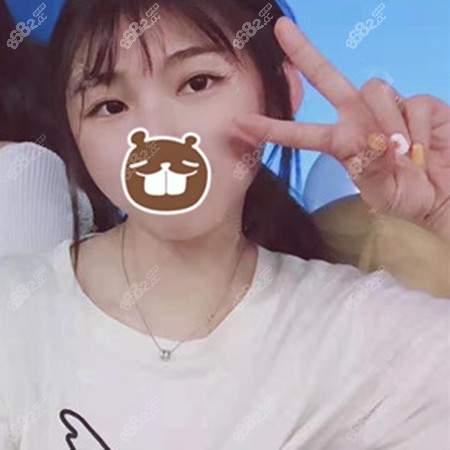 做眼综合三个月后的状态 做眼综合三个月后的状态