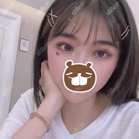 做眼综合一个月后眼睛还是有肿胀感 做眼综合一个月后眼睛还是有肿胀感