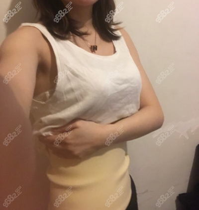 北京吴宇宏给我做腰腹环吸第3天