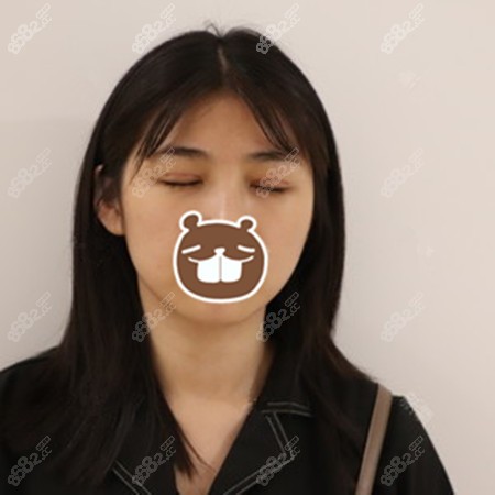 做双眼皮七天后拆线 做双眼皮七天后拆线