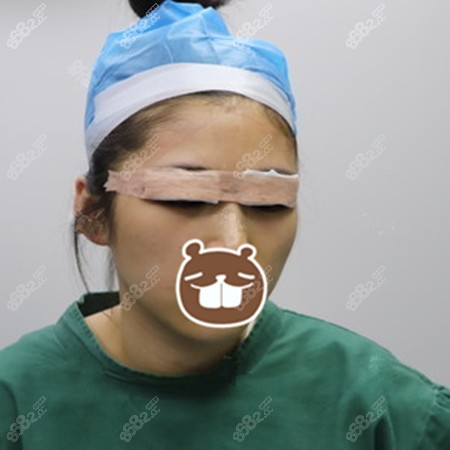 到佛山华美做眼综合后即刻效果 到佛山华美做眼综合后即刻效果