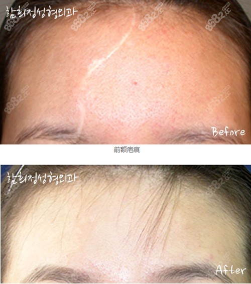 韩国Dr.ham's整形医院疤痕修复对比照