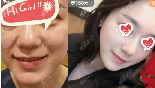 面部热玛吉案例