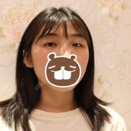 雷朝勇医生做双眼皮的优势 雷朝勇医生做双眼皮的优势