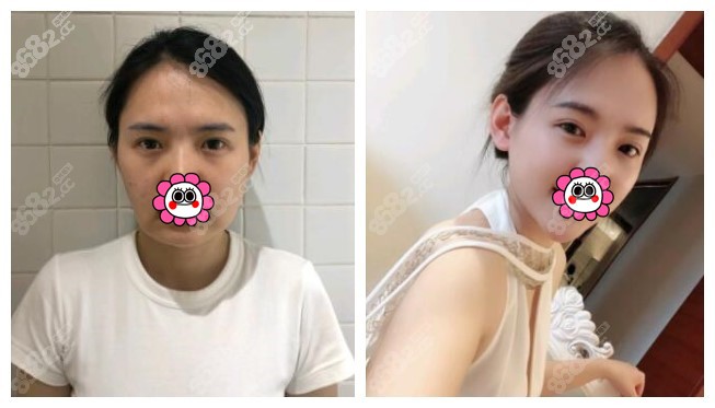 重庆时光<!--<i data=20240705-sp></i>-->下颌角整形对比效果图