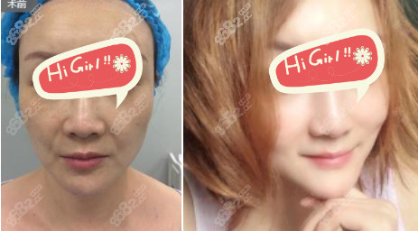 武汉Loveme乐美整形埋线提升口碑好的案例