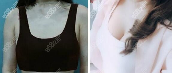 美莱<!--<i data=20240705-sp></i>-->医生脂肪填充丰胸案例：恢复三个月效果对比图