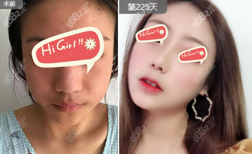 <!--<i data=20240705-sp></i>-->口碑好的隆鼻案例