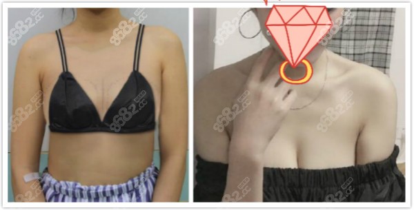 北京美莱<!--<i data=20240705-sp></i>-->医生自体脂肪丰胸案例效果对比