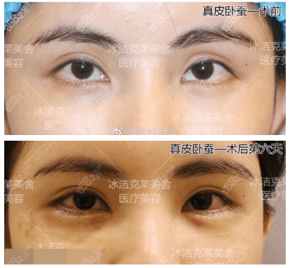 张冰洁真皮卧蚕案例图