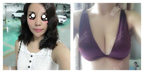 <!--<i data=20240705-sp></i>-->医生做自体脂肪丰胸前后对比效果图