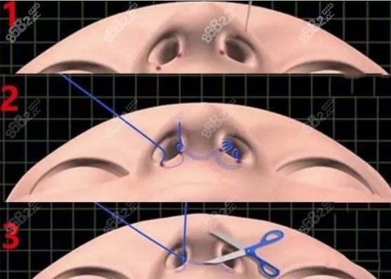 内切法鼻翼缩小术手术原理