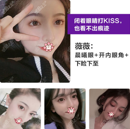 杭州美莱晨曦眼案例