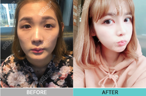 韩国珠儿丽隆鼻术前术后对比照