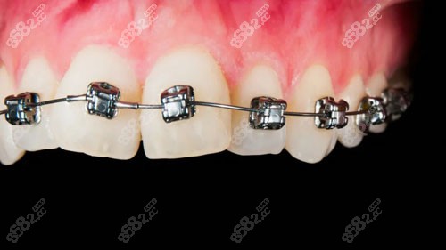 牙齿矫正会有后遗症和危害吗？