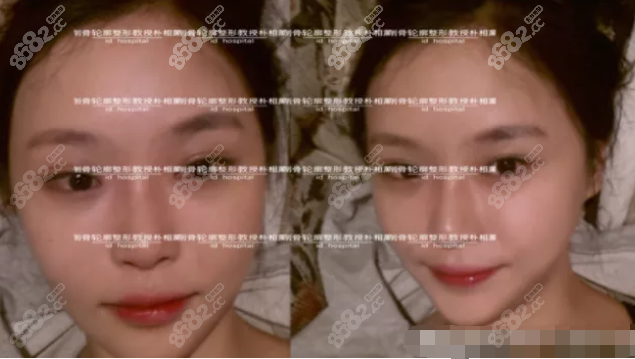 面部骨骼整形術后一個月恢復
