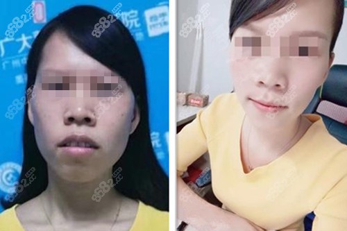 广州广大何锦泉面部不对称矫正案例