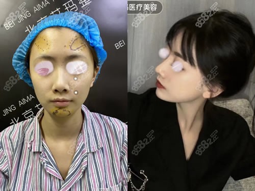 北京艾玛整形医院假体隆鼻图