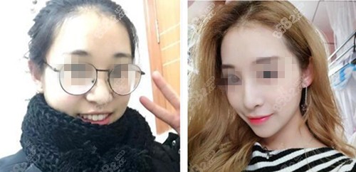 广州广大巫国辉肋骨鼻综合案例
