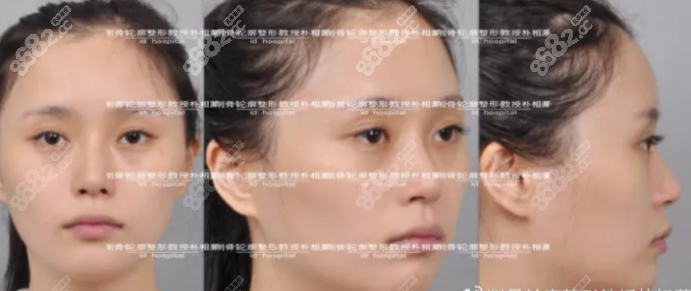 術前臉頰顴骨高，有輕微凸嘴