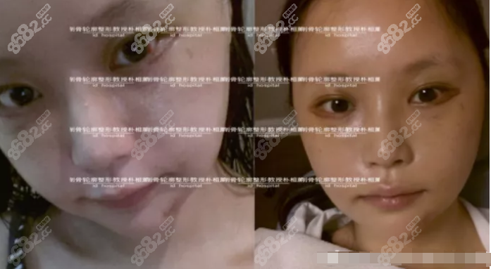 顴骨+下頜角整形術后一周效果