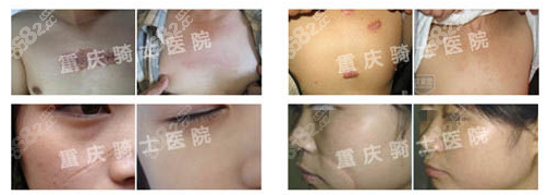 重庆骑士医院疤痕修复科去疤痕效果怎么样？案例效果了解
