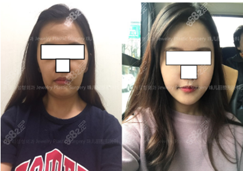 韩国珠儿丽整形医院下颌角手术前后对比照