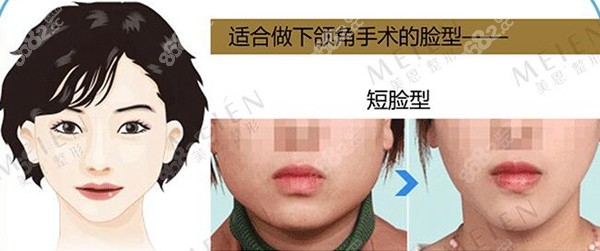 廣州美恩短臉型做下頜角手術(shù)效果