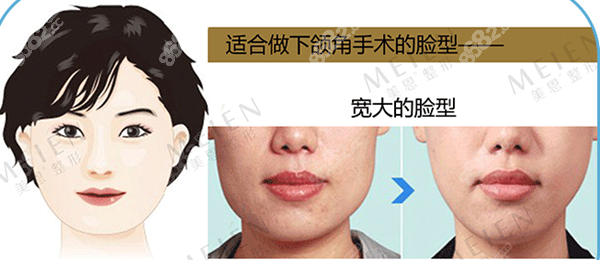 廣州美恩下頜角寬大磨骨案例