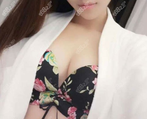 郑州缔莱美整形医院假体隆胸术后60天