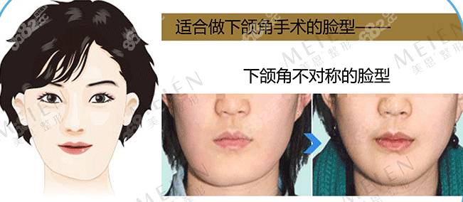廣州美恩下頜角不對稱矯正案例