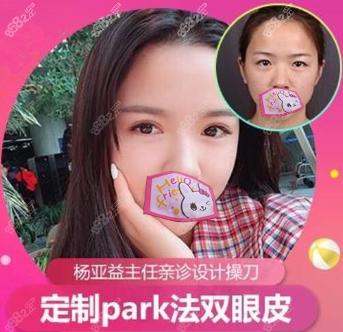 定制park法双眼皮真人对比案例