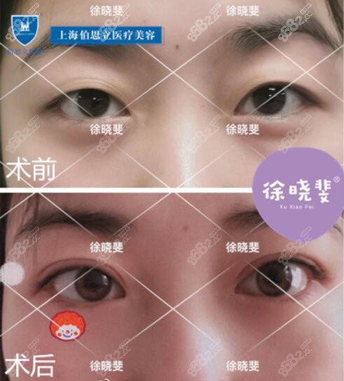 徐晓斐双眼皮真人案例前后对比照
