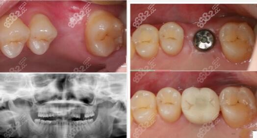种植牙实例疗效对比图