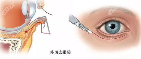 眼袋修复手术过程