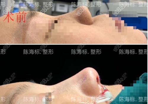 上海知颜陈海标做肋骨鼻术后即刻图