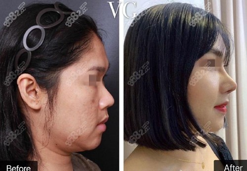 韩国VG整形外科鼻部整形案例