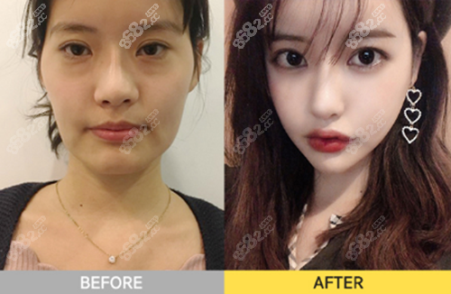 韩国珠儿丽整形外科医院面部轮廓+鼻部整形案例