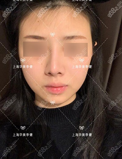 李健做鼻子修复手术术前照片