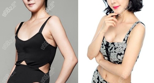韩国必当归整形外科隆胸案例