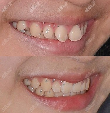 牙齿矫正后正常微笑对比